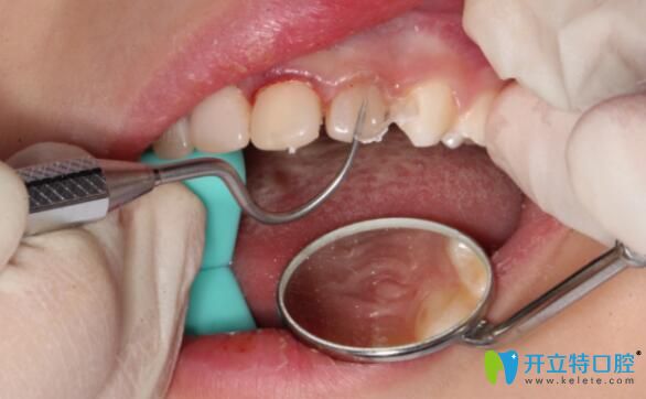 透明預(yù)成冠充填樹脂