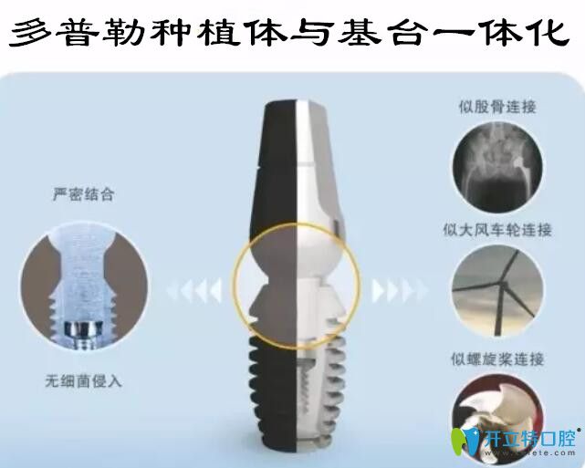 韓國多普勒種植牙優(yōu)勢