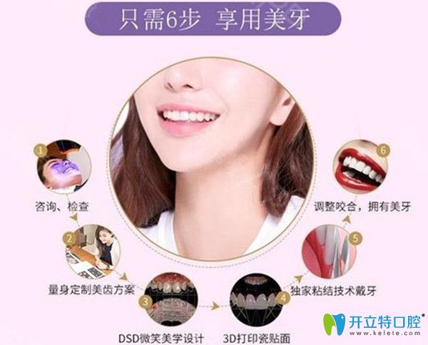 牙貼面的過(guò)程