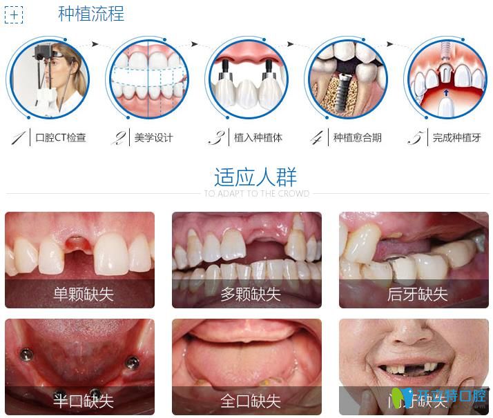 種植牙的流程與適應(yīng)人群