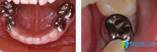 金屬預(yù)成冠