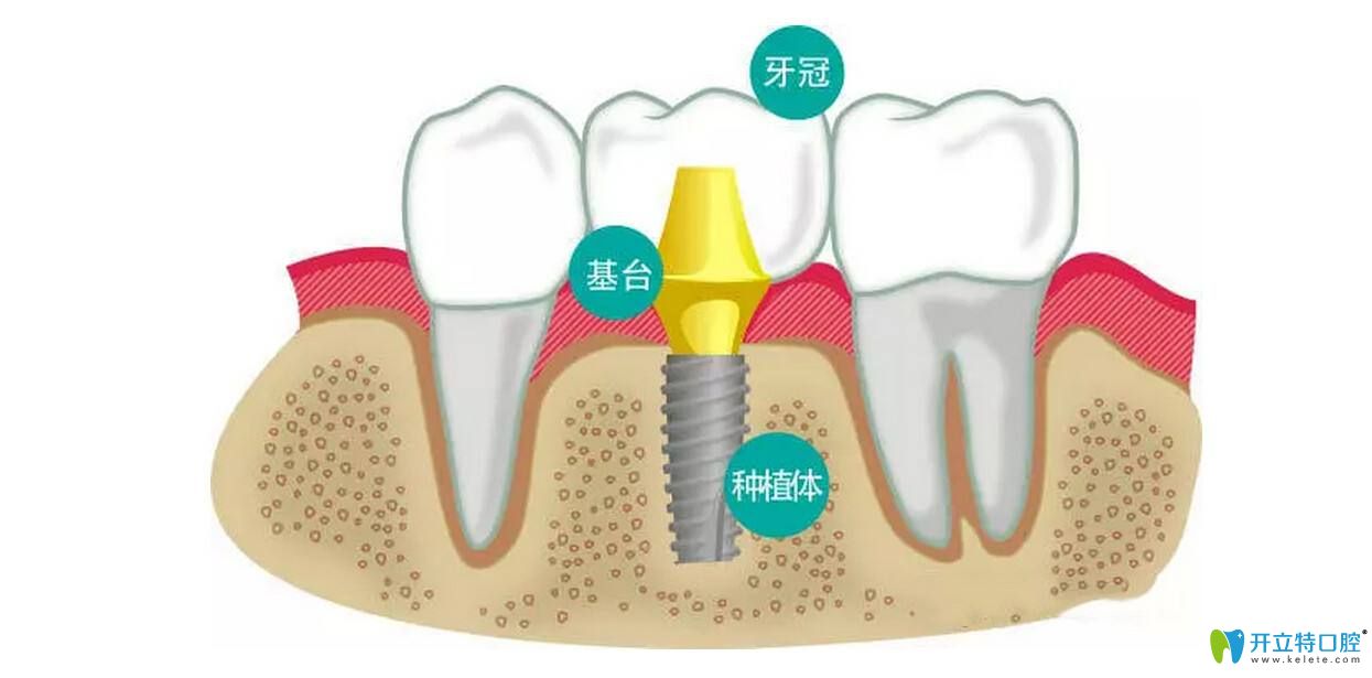 惠州種植牙多少錢(qián)一顆?分享惠州各口腔醫(yī)院種牙收費(fèi)價(jià)格表
