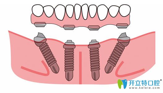 all-on-4速導種植牙技術