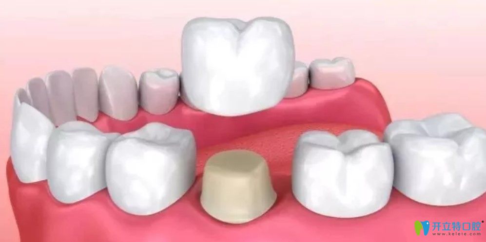 全瓷牙和烤瓷牙哪個(gè)好
