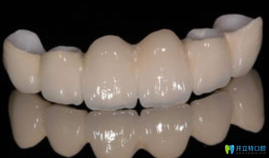 口腔寶典：惠州全瓷牙多少錢一顆？全瓷牙和烤瓷牙哪個好