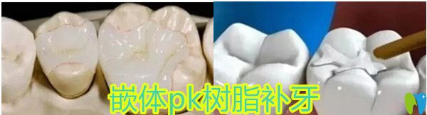傳統(tǒng)補牙PK 嵌體修復