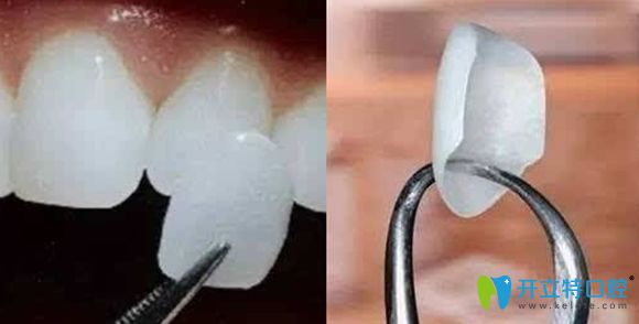 牙齒貼面多少錢一顆的價(jià)格展示