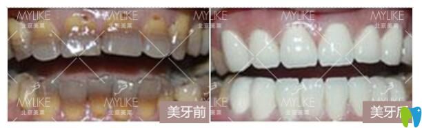 北京美萊口腔牙齒貼面前后對比圖