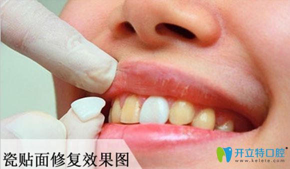 牙齒貼面修復(fù)效果圖