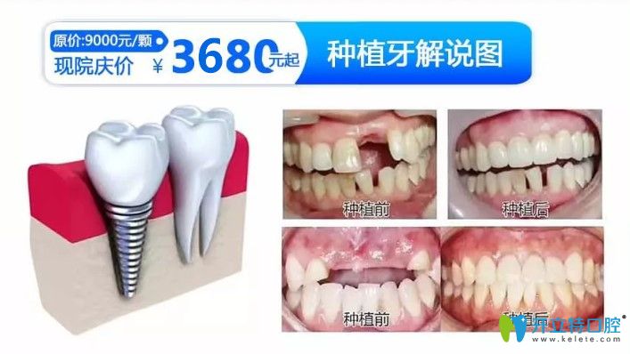 重慶齊美口腔種植牙價格及案例