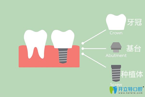完整的種植牙由牙冠 基臺(tái) 種植體合成