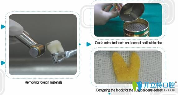 自體牙種植過程