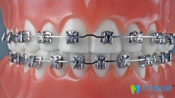 從適應范圍和經濟方面比較，固定矯治要比隱形矯治略勝一籌