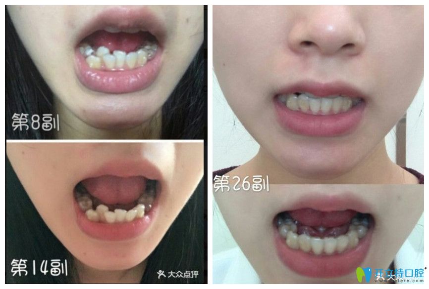 在美萊口腔做時代天使隱形矯正對比圖