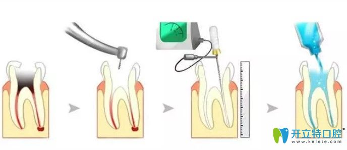 根管治療后為什么要做牙冠