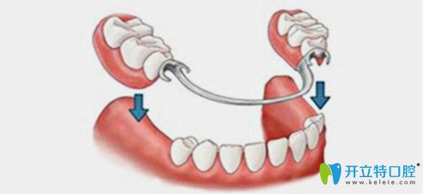 鑲牙的種類以及鑲牙的費(fèi)用