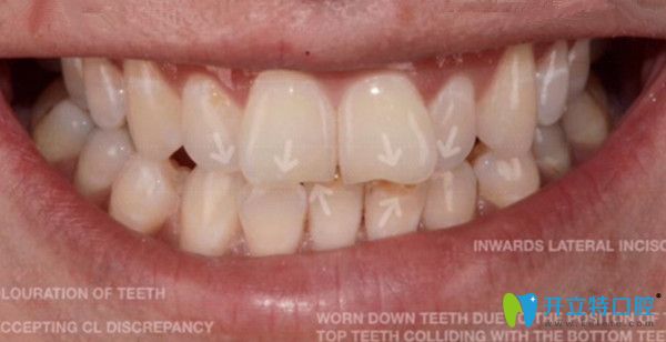 曬北京美萊戴金屬牙套矯正前后對(duì)比照,并說(shuō)下摘牙套的感覺(jué)