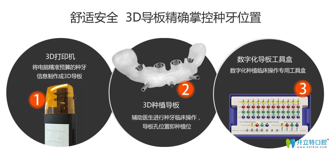 3D導(dǎo)板種植牙技術(shù)