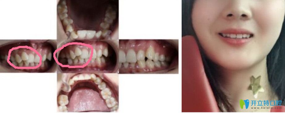 虎牙在伊爾意矯正前后對(duì)比照