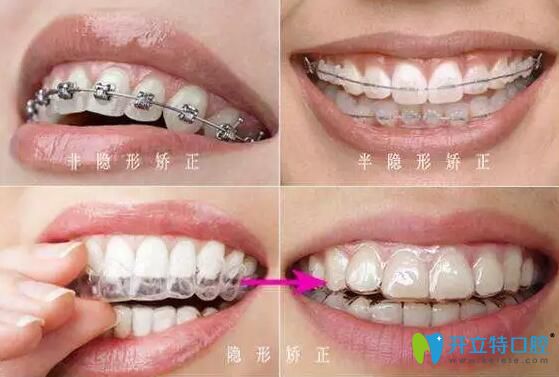 記錄在深圳南山正規(guī)牙科醫(yī)院好佰年口腔做的牙齒矯正體驗