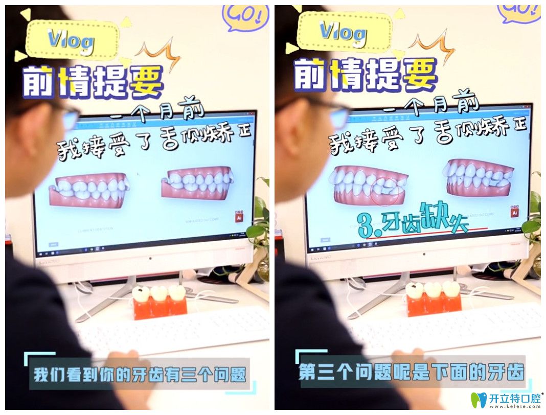 來看找上海維樂口腔楊國平做舌側(cè)矯正的人是怎么評(píng)價(jià)他的