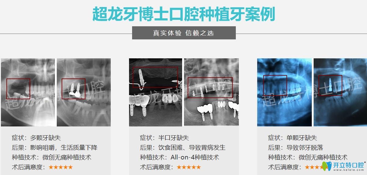 長春超龍牙博士口腔種植牙案例