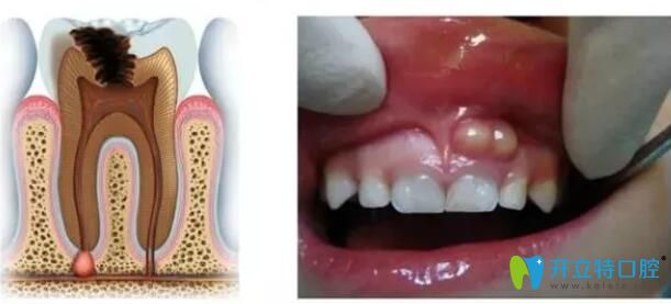 兒童牙齦膿包疙瘩怎么辦,指望自愈易反復(fù),收下這份治療指南