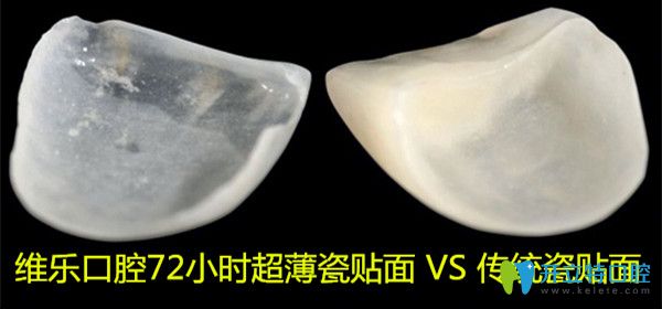 做16顆牙齒貼面要多久?別錯(cuò)過(guò)上海維樂(lè)口腔72小時(shí)美學(xué)貼面