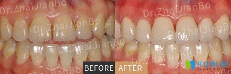 超薄瓷貼面美牙前后對(duì)比圖片
