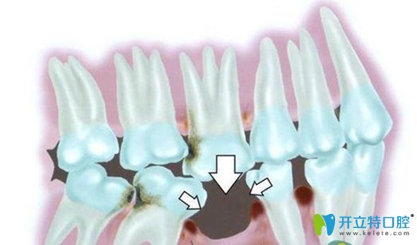 歐諾口腔科普牙齒缺失的危害以及做種植牙的必要