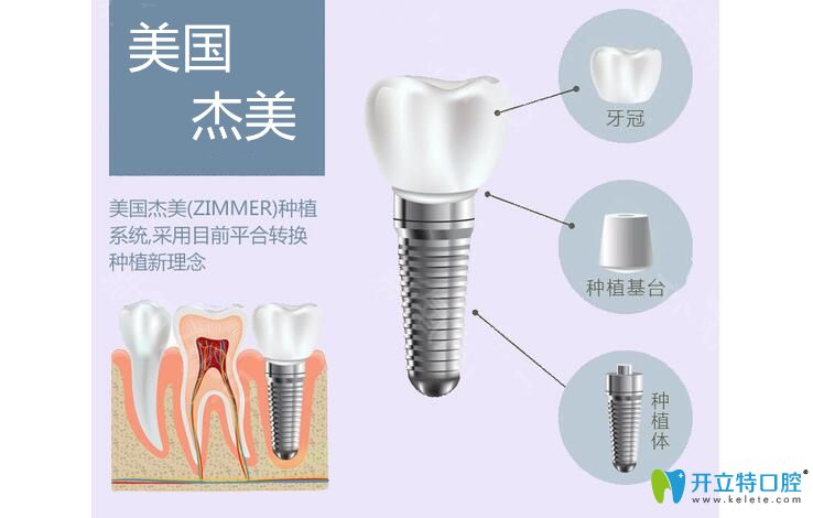 美國(guó)杰美種植體怎么樣以及zimmer種植牙價(jià)格，讓你5分鐘悉知