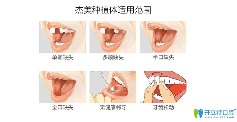 杰美種植牙適用范圍