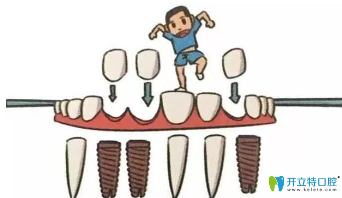 種植體形狀螺紋設(shè)計