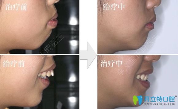 成都兒童牙齒矯正哪家醫(yī)院醫(yī)生好?誠(chéng)意推薦茁悅口腔李文星