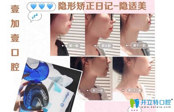 通過隱適美矯正改善齙牙突嘴真人案例