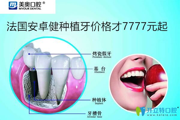 忒狠！聽說上海美奧口腔法國安卓健種植牙價格7777元起