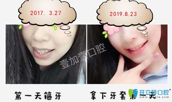 在壹加壹口腔做陶瓷半隱形矯正一年五個(gè)月效果圖