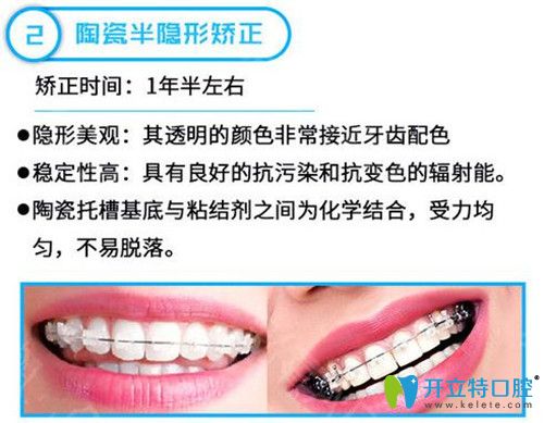 陶瓷半隱形矯正