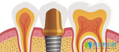 缺牙影響臉型，顯老