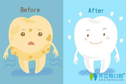 牙齒美白前后對比示意圖