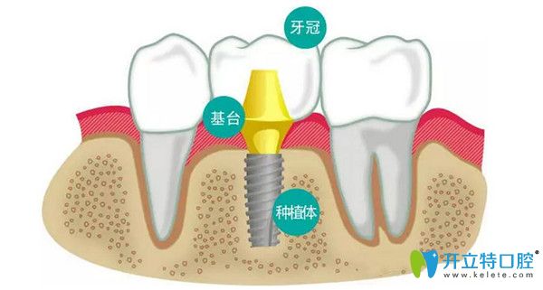 種植牙分為三大部分