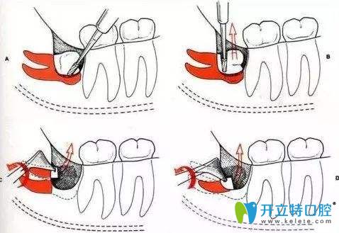 拔牙過(guò)程
