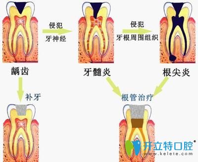 根尖周炎的形成
