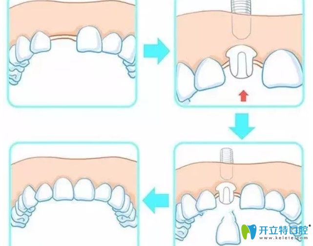 為啥這么多人選擇即刻種植牙