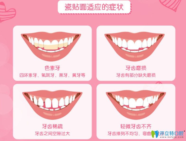 牙齒貼面適合的癥狀