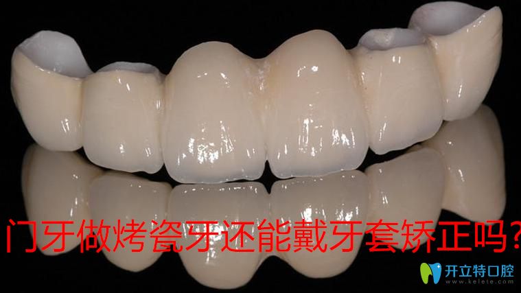 先了解門牙做烤瓷牙還能戴牙套矯正嗎?避免烤瓷牙正畸后悔