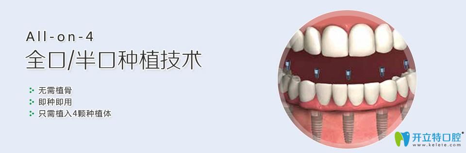 All-on-4即刻種植牙圖片