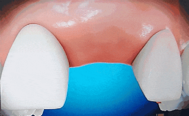 微創(chuàng)種植牙過程