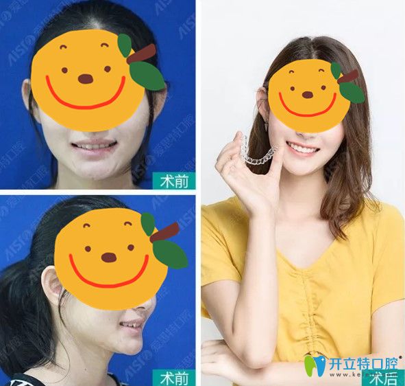 在愛思特矯正牙齒之后側臉有了小改變