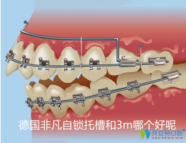 同樣身為進(jìn)口自鎖托槽品牌,德國(guó)非凡自鎖牙套和3m哪個(gè)好呢